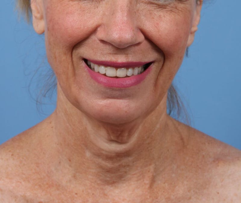 Facelift Before & After Gallery - Patient 291138 - Image 3