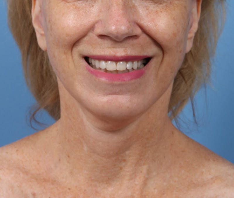 Facelift Before & After Gallery - Patient 291138 - Image 4