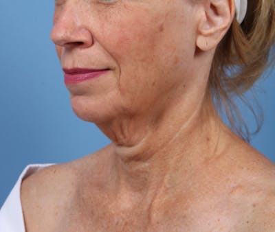 Facelift Before & After Gallery - Patient 291138 - Image 1