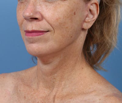 Facelift Before & After Gallery - Patient 291138 - Image 2