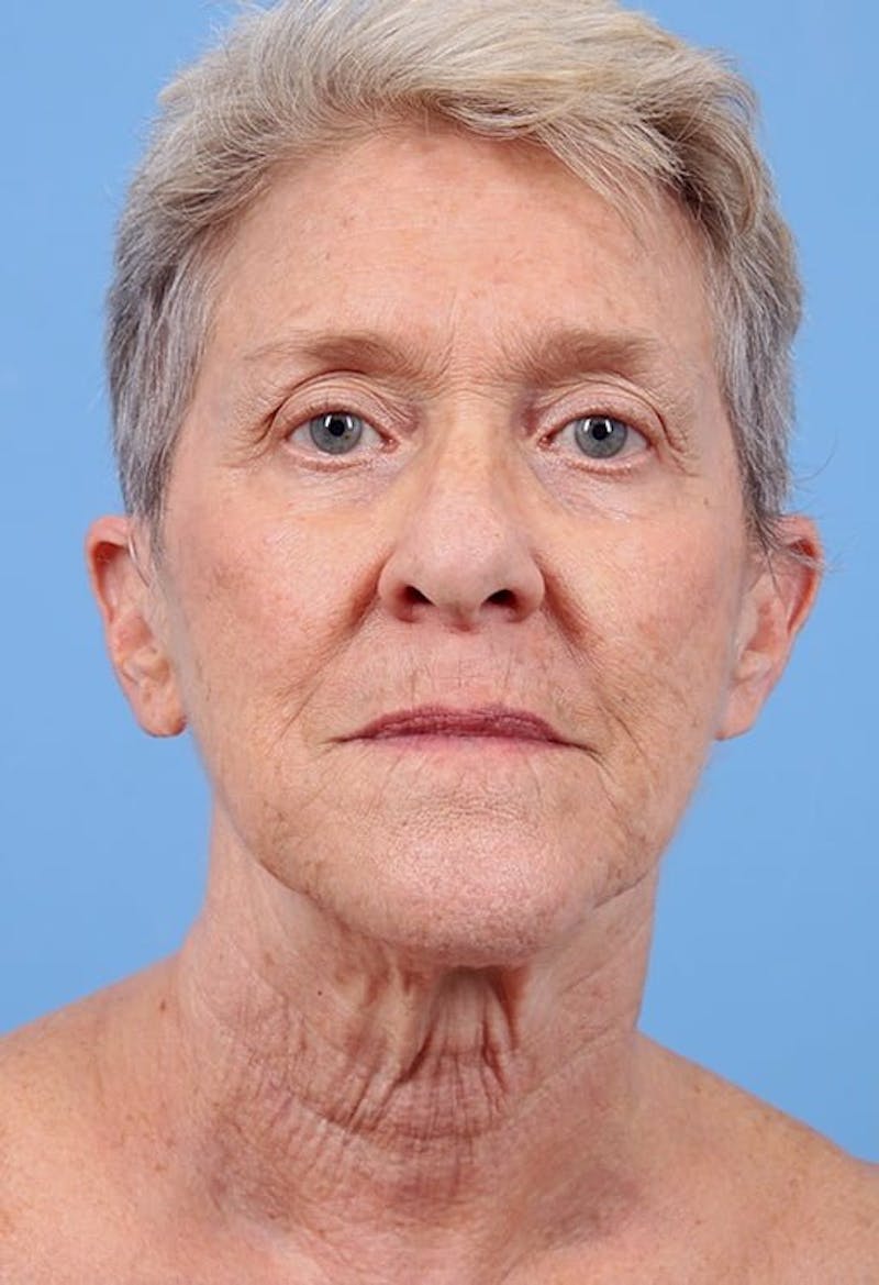 Facelift Before & After Gallery - Patient 218702 - Image 3