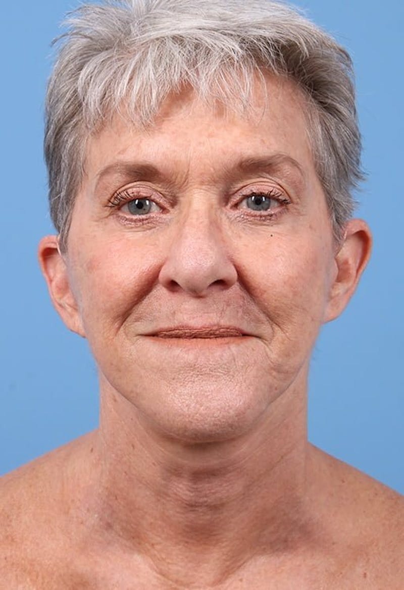 Facelift Before & After Gallery - Patient 218702 - Image 4