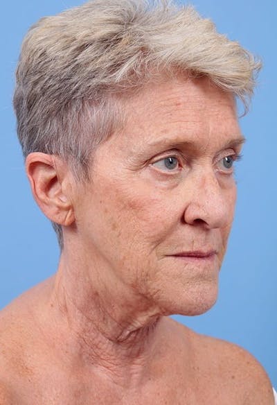 Facelift Before & After Gallery - Patient 218702 - Image 1