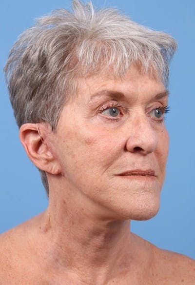 Facelift Before & After Gallery - Patient 218702 - Image 2