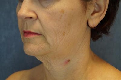 Facelift Before & After Gallery - Patient 522478 - Image 1