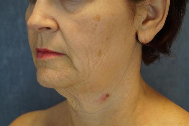 Facelift Before & After Gallery - Patient 522478 - Image 1