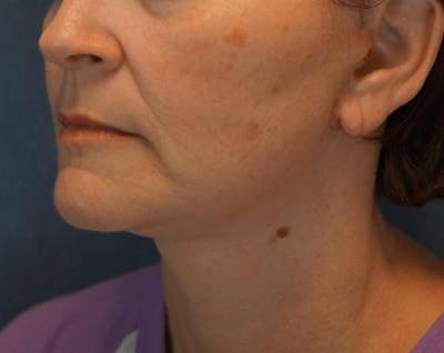 Facelift Before & After Gallery - Patient 522478 - Image 2