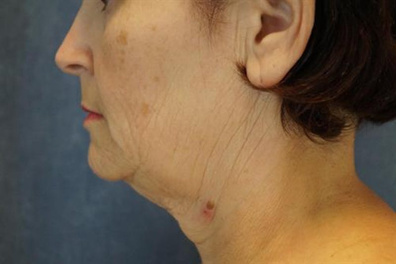 Facelift Before & After Gallery - Patient 522478 - Image 3