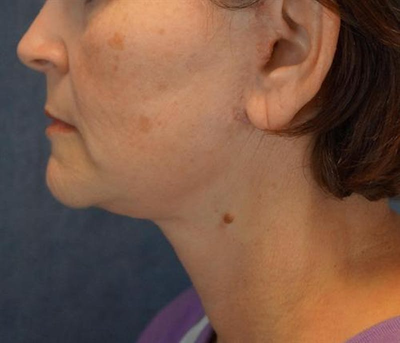 Facelift Before & After Gallery - Patient 522478 - Image 4