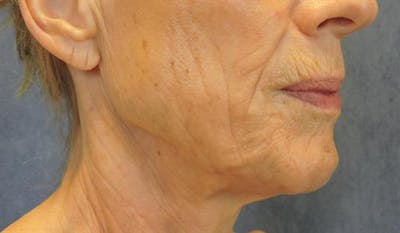 Facelift Before & After Gallery - Patient 203287 - Image 1