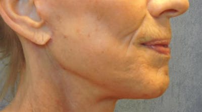 Facelift Before & After Gallery - Patient 203287 - Image 2