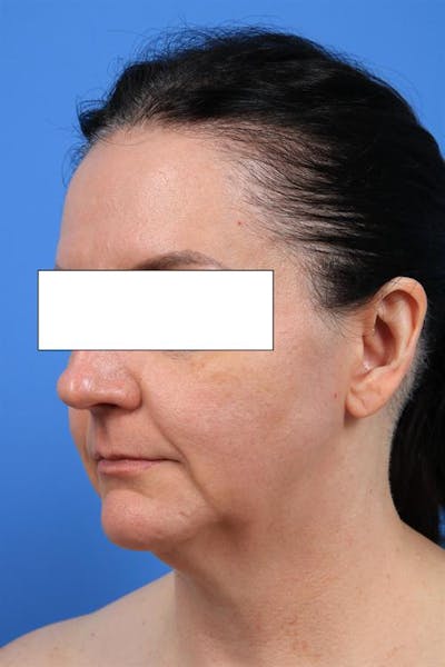 Facelift Before & After Gallery - Patient 537342 - Image 1