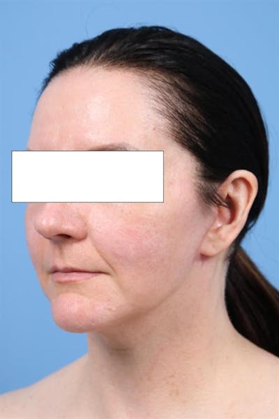 Facelift Before & After Gallery - Patient 537342 - Image 2