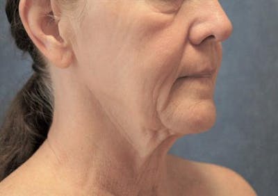 Facelift Before & After Gallery - Patient 842634 - Image 1