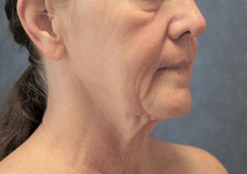 Facelift Before & After Gallery - Patient 842634 - Image 1