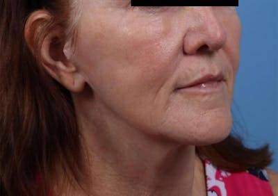 Facelift Before & After Gallery - Patient 842634 - Image 2