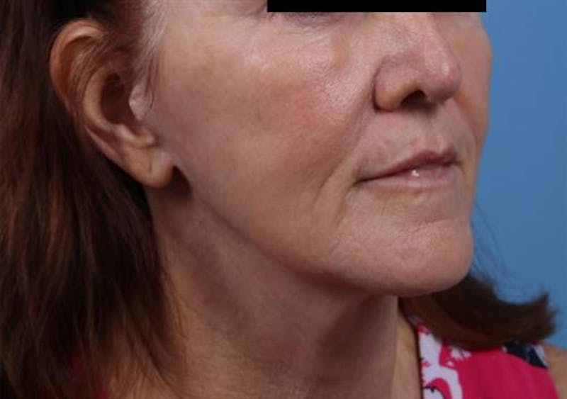 Facelift Before & After Gallery - Patient 842634 - Image 2
