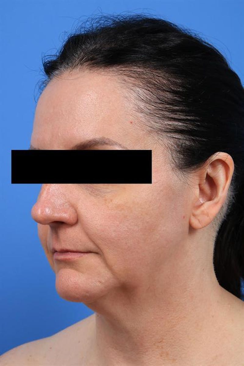 Facelift Before & After Gallery - Patient 842634 - Image 3