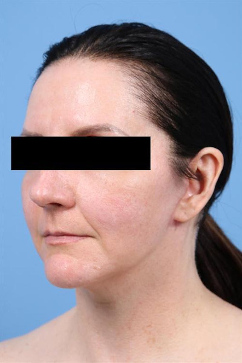 Facelift Before & After Gallery - Patient 842634 - Image 4