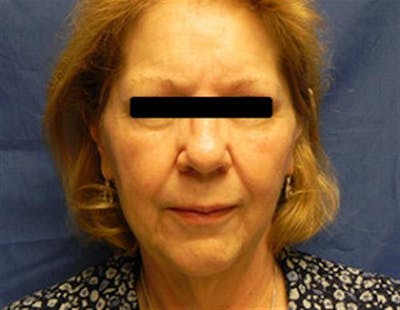 Facelift Before & After Gallery - Patient 321120 - Image 1