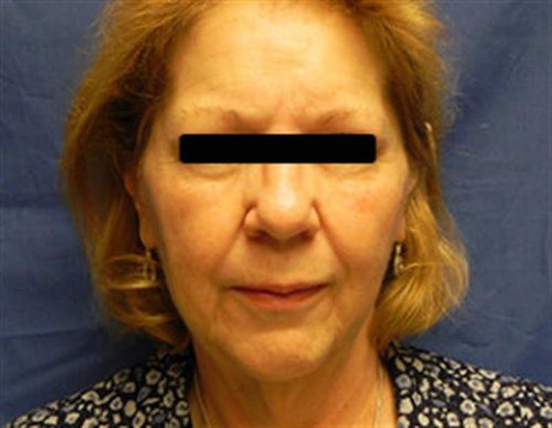 Facelift Before & After Gallery - Patient 321120 - Image 1