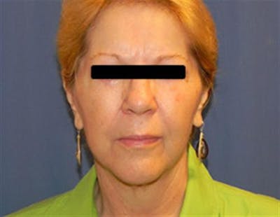 Facelift Before & After Gallery - Patient 321120 - Image 2