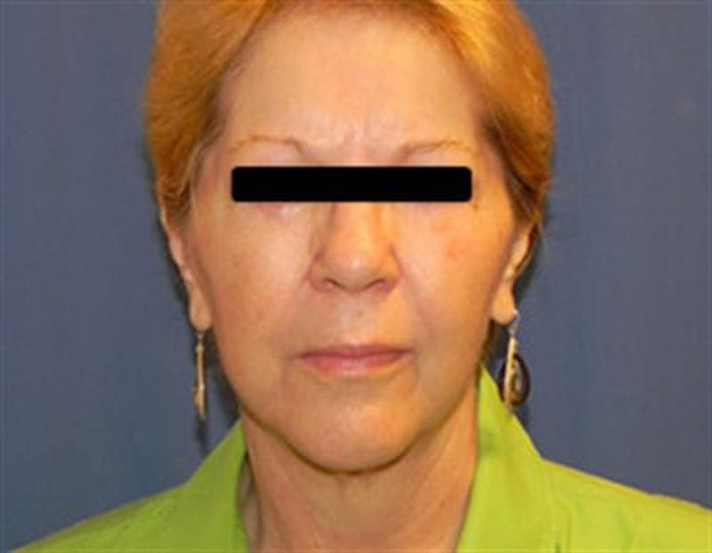 Facelift Before & After Gallery - Patient 321120 - Image 2