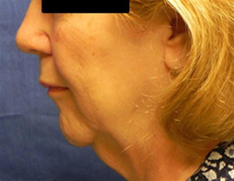 Facelift Before & After Gallery - Patient 321120 - Image 5