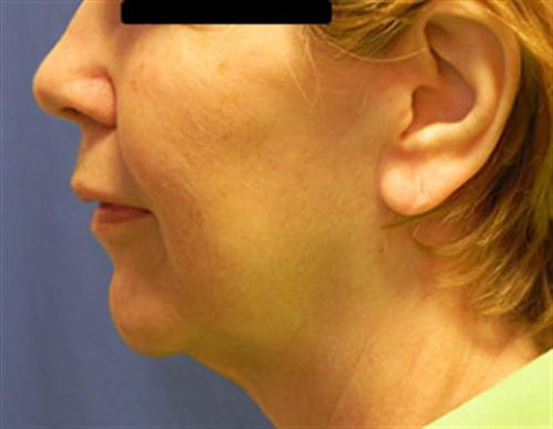 Facelift Before & After Gallery - Patient 321120 - Image 6