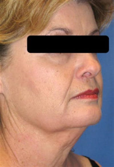 Facelift Before & After Gallery - Patient 214997 - Image 1