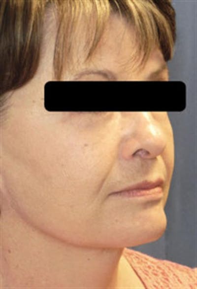 Facelift Before & After Gallery - Patient 214997 - Image 2