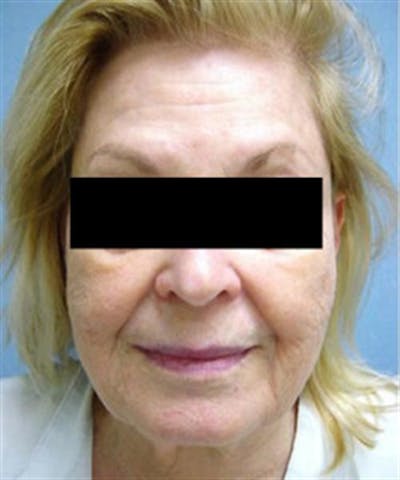 Facelift Before & After Gallery - Patient 788933 - Image 1