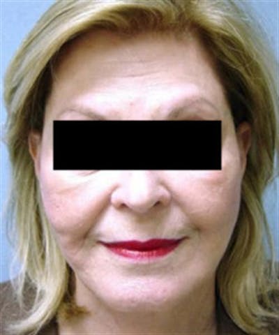 Facelift Before & After Gallery - Patient 788933 - Image 2