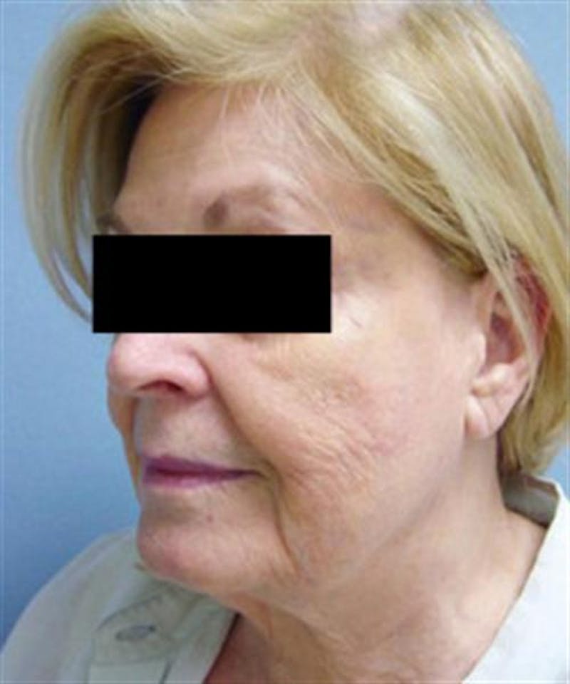 Facelift Before & After Gallery - Patient 788933 - Image 3