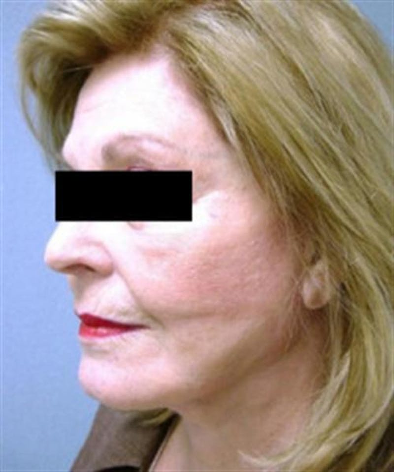 Facelift Before & After Gallery - Patient 788933 - Image 4