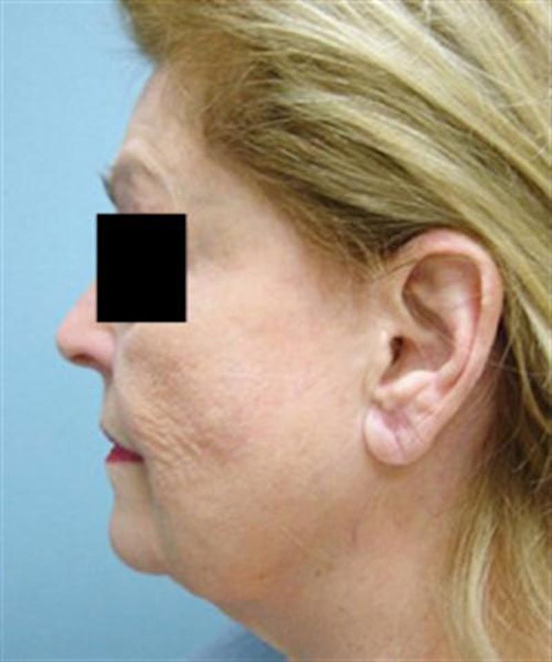 Facelift Before & After Gallery - Patient 788933 - Image 5