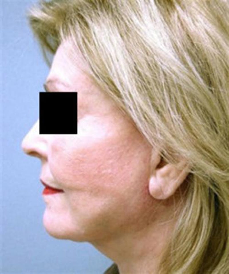 Facelift Before & After Gallery - Patient 788933 - Image 6