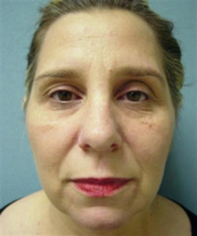Facelift Before & After Gallery - Patient 113111 - Image 1