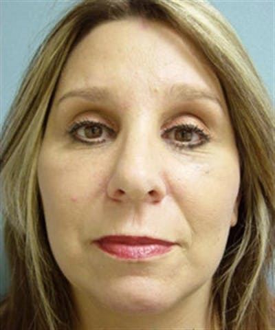 Facelift Before & After Gallery - Patient 113111 - Image 2
