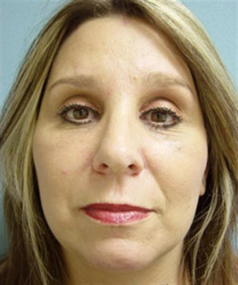 Facelift Before & After Gallery - Patient 113111 - Image 2