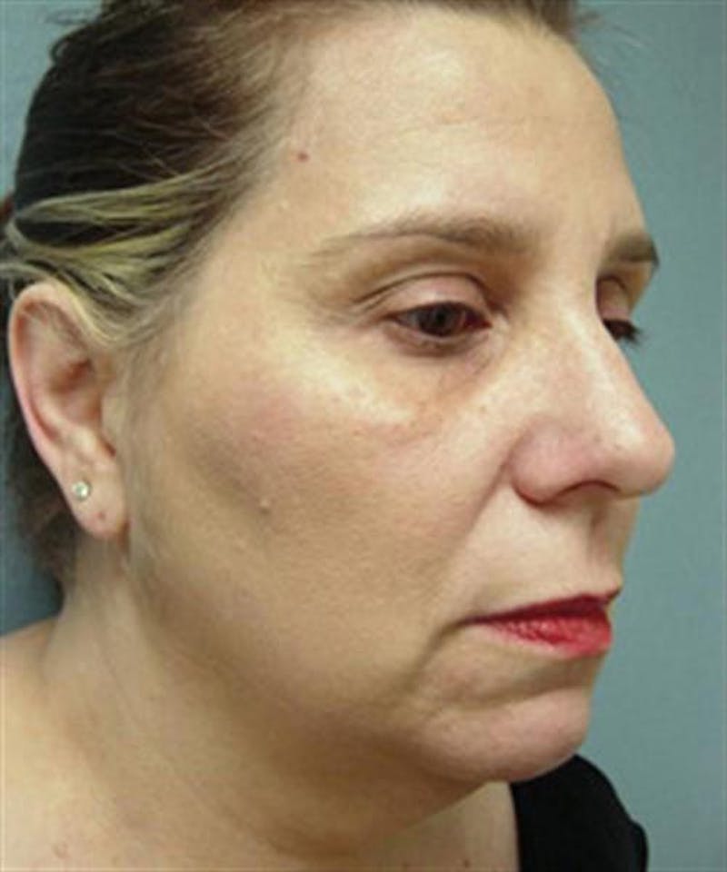 Facelift Before & After Gallery - Patient 113111 - Image 3