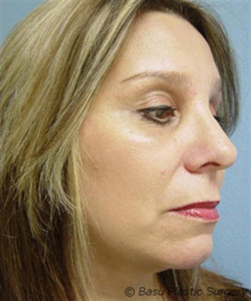 Facelift Before & After Gallery - Patient 113111 - Image 4