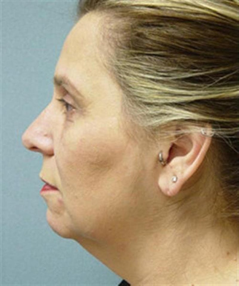 Facelift Before & After Gallery - Patient 113111 - Image 5