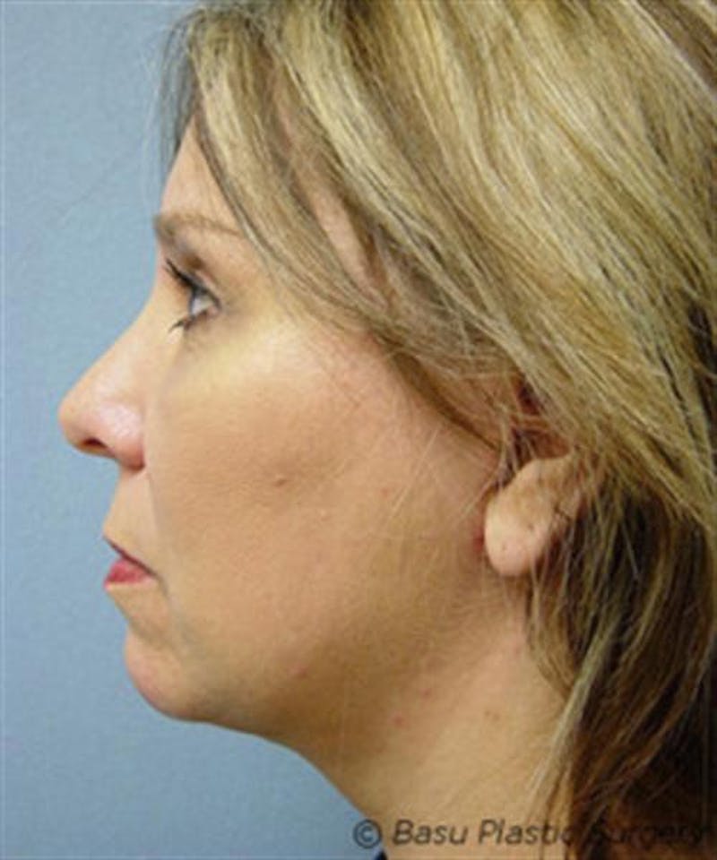 Facelift Before & After Gallery - Patient 113111 - Image 6
