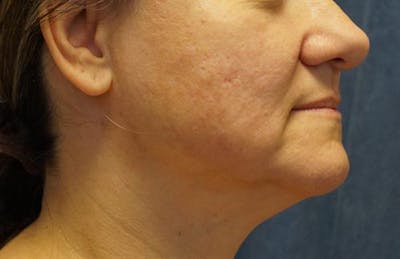 Facelift Before & After Gallery - Patient 390220 - Image 1