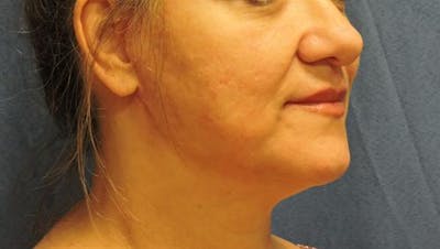 Facelift Before & After Gallery - Patient 390220 - Image 2
