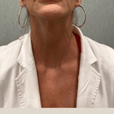 Injectables (BOTOX) Before & After Gallery - Patient 198000 - Image 2