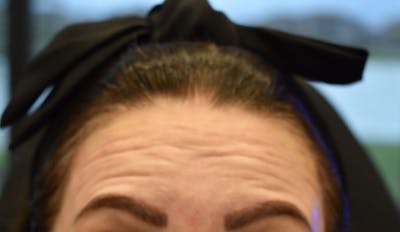 Injectables (BOTOX) Before & After Gallery - Patient 968169 - Image 1
