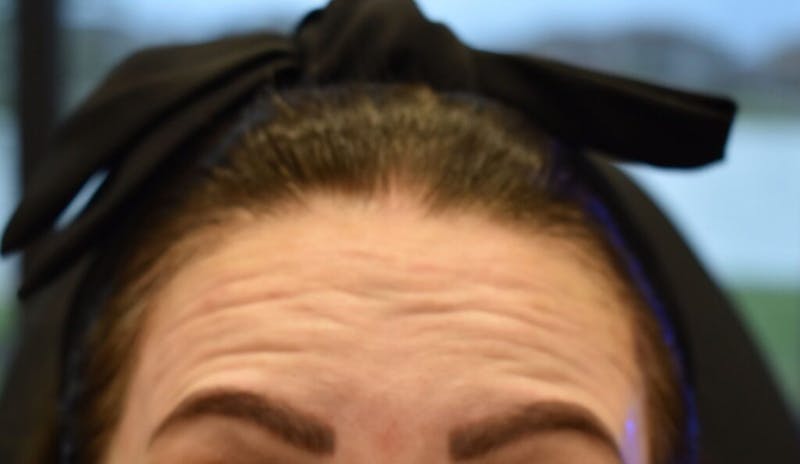 Injectables (BOTOX) Before & After Gallery - Patient 968169 - Image 1