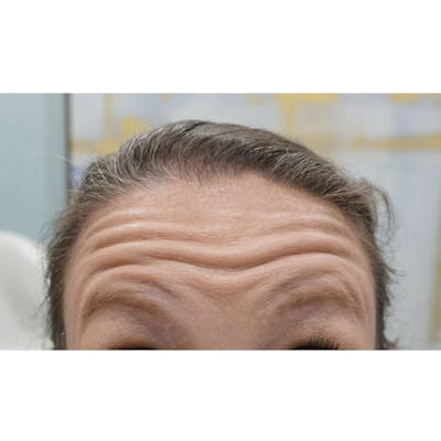 Injectables (BOTOX) Before & After Gallery - Patient 227738 - Image 1